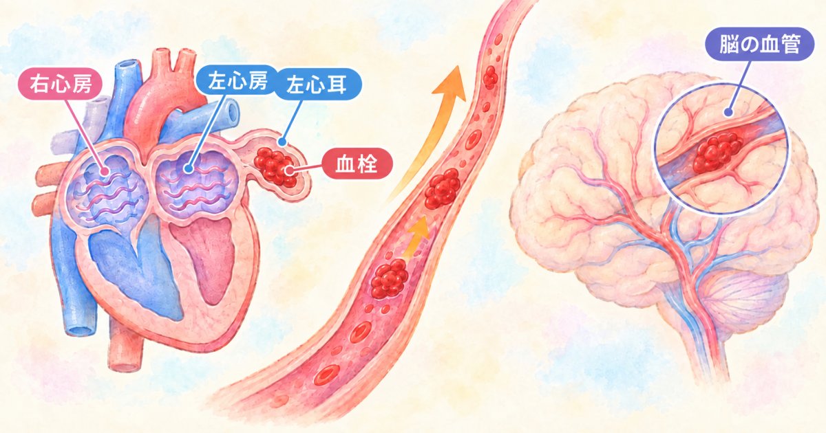 心房細動を放置すると、なぜ脳梗塞につながるのか